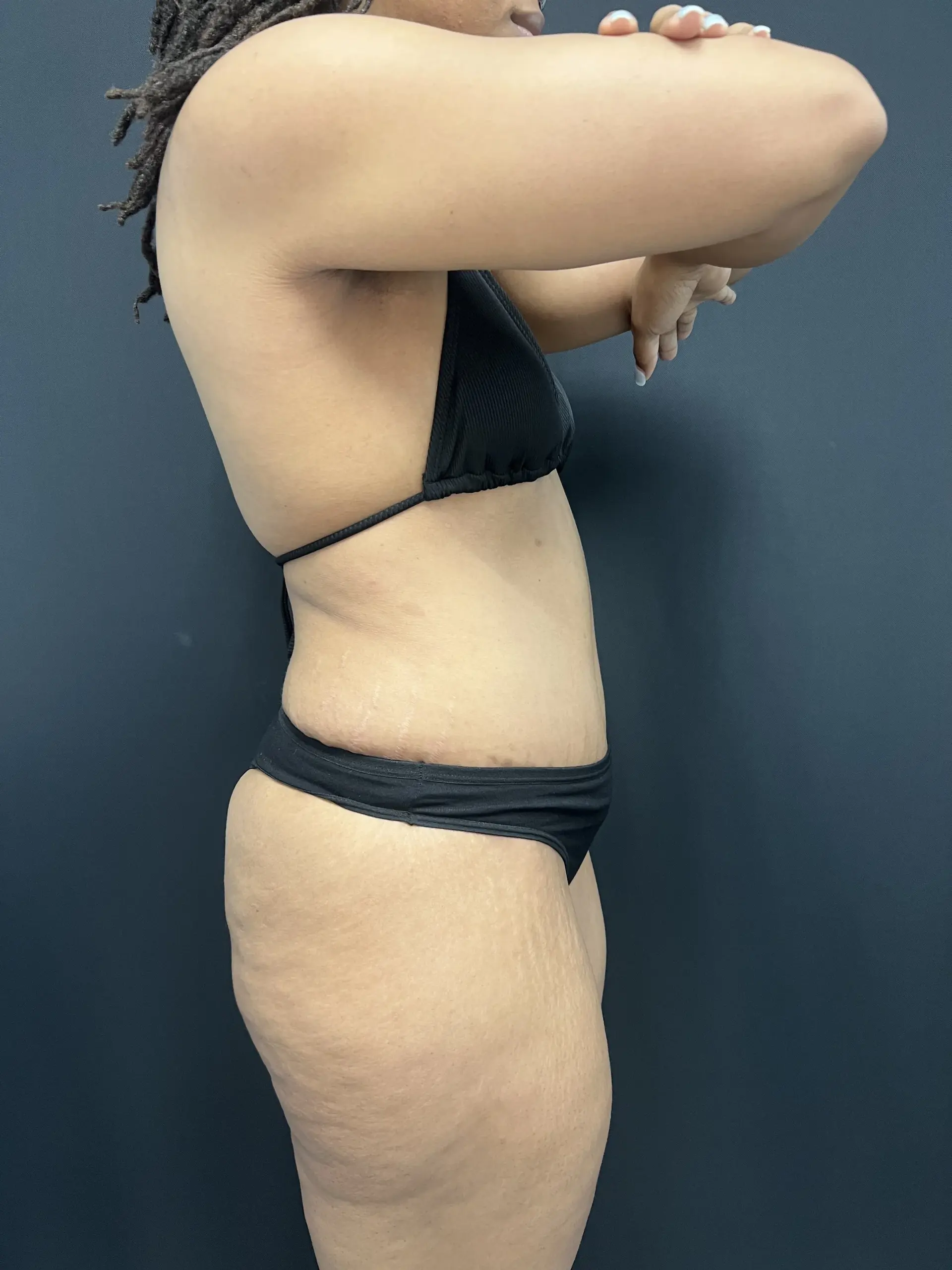 Mafi Plastic Surgery tummy tuck after — Fresno, CA