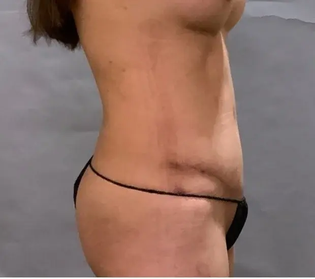 Mafi Plastic Surgery after — Fresno, CA
