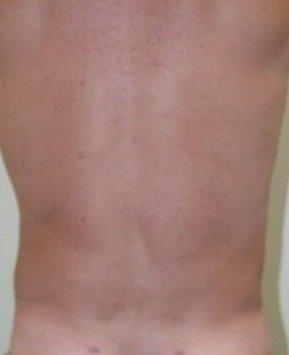 Andrew Barnett, MD liposuction after — Walnut Creek, CA