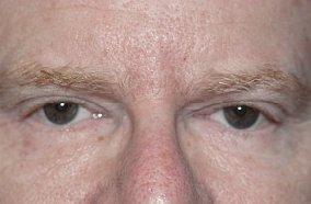Andrew Barnett, MD eyelid lift after — Walnut Creek, CA