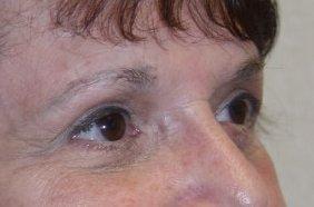 Andrew Barnett, MD eyelid lift after — Walnut Creek, CA