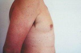 Andrew Barnett, MD liposuction after — Walnut Creek, CA