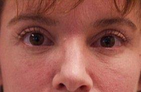 Andrew Barnett, MD eyelid lift after — Walnut Creek, CA
