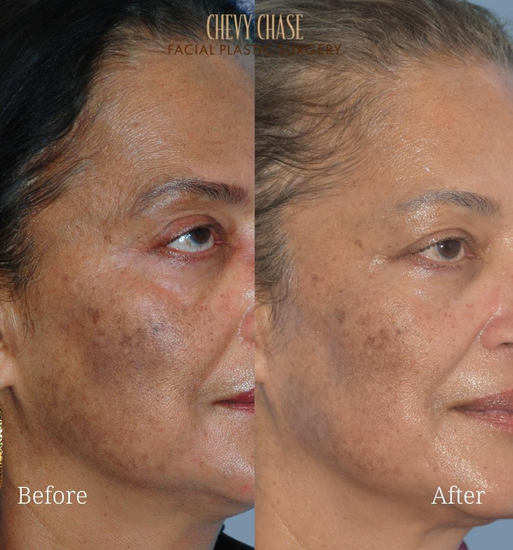 Chevy Chase Facial Plastic Surgery (Jennifer Parker Porter, MD) laser treatment result — Bethesda, MD