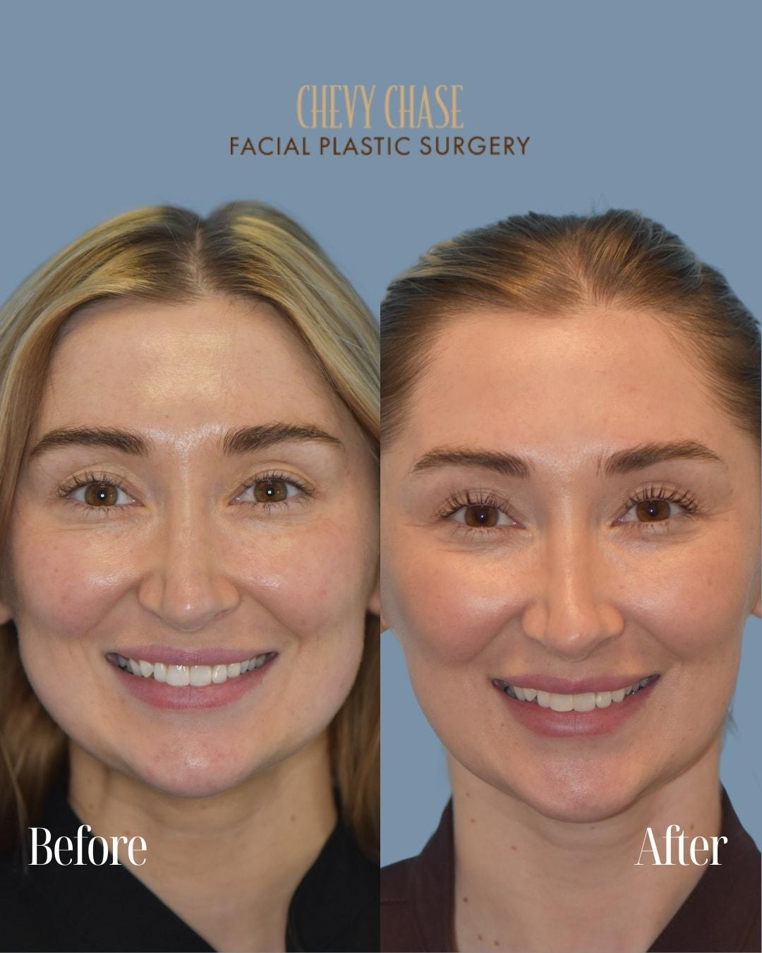Chevy Chase Facial Plastic Surgery (Jennifer Parker Porter, MD) botox result — Bethesda, MD