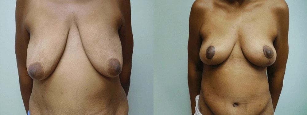 Steven J. Rottman, MD breast lift result — Owings Mills, MD