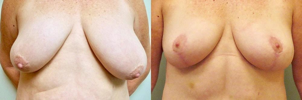 Steven J. Rottman, MD breast lift result — Owings Mills, MD