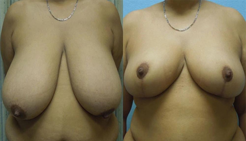 Steven J. Rottman, MD breast reduction result — Owings Mills, MD