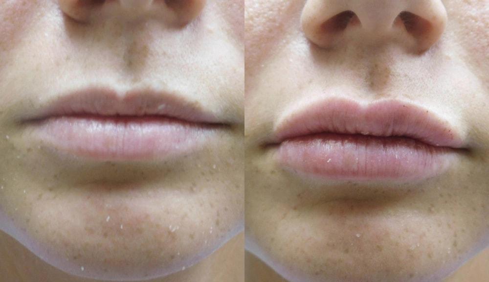 Steven J. Rottman, MD lip filler result — Owings Mills, MD