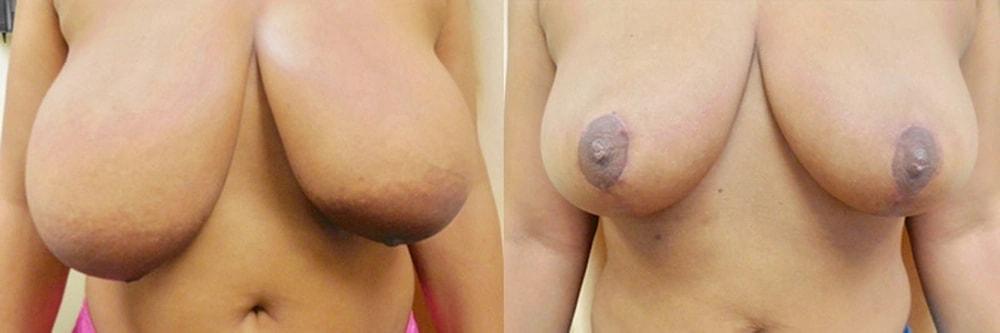 Steven J. Rottman, MD breast lift result — Owings Mills, MD