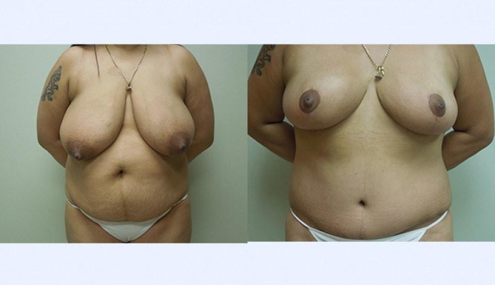 Steven J. Rottman, MD breast reduction result — Owings Mills, MD
