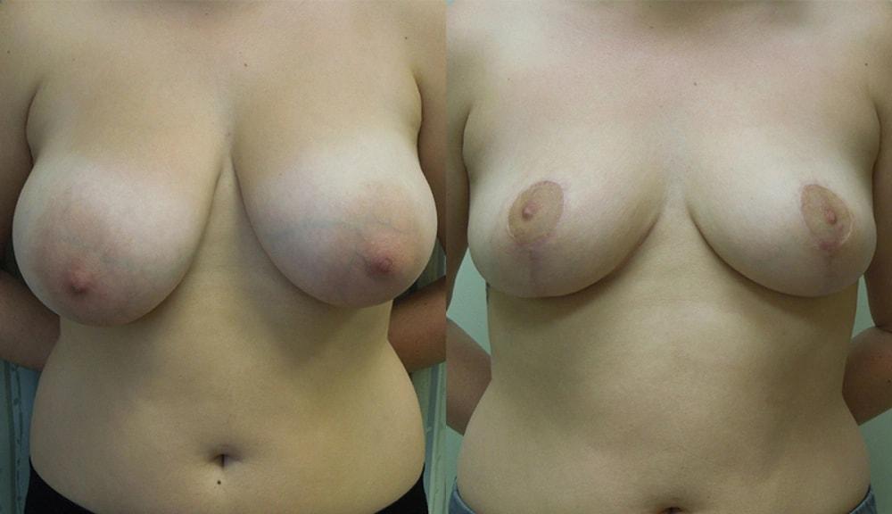 Steven J. Rottman, MD breast reduction result — Owings Mills, MD