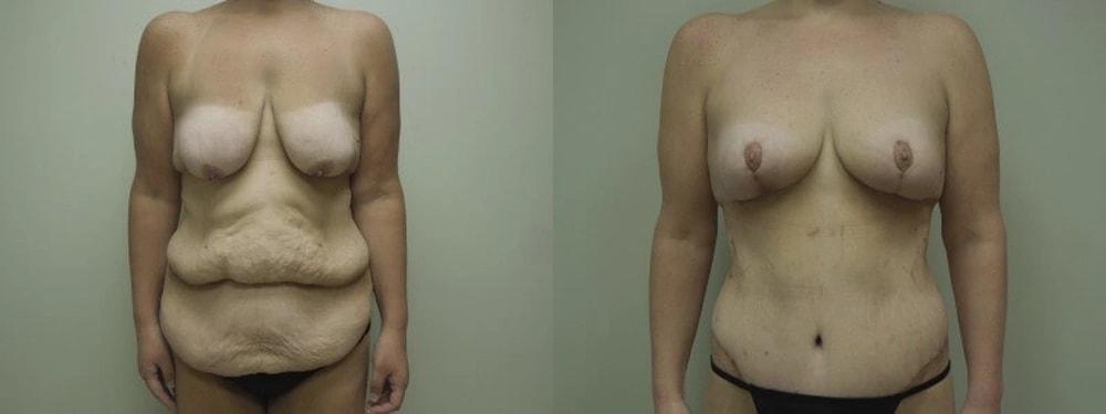 Steven J. Rottman, MD mommy makeover result — Owings Mills, MD