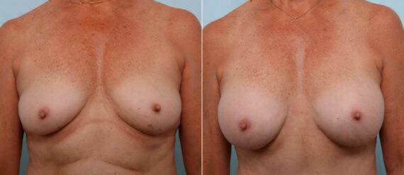Breast Augmentation result at Vitenas Cosmetic Surgery in Houston, TX