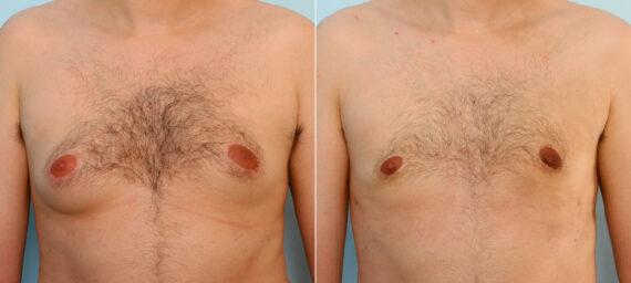 Vitenas Cosmetic Surgery result — Houston, TX