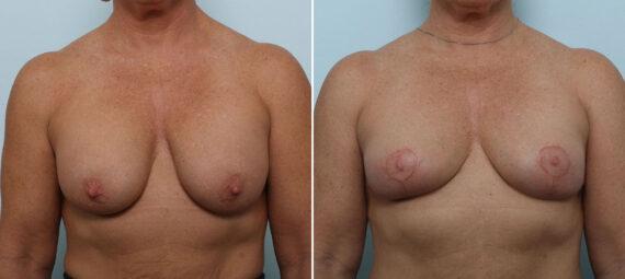 Vitenas Cosmetic Surgery breast augmentation result — Houston, TX