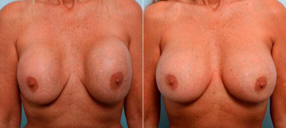 Vitenas Cosmetic Surgery result — Houston, TX