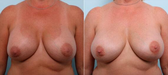 Vitenas Cosmetic Surgery breast augmentation result — Houston, TX