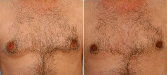 Gynecomastia Surgery result at Vitenas Cosmetic Surgery in Houston, TX