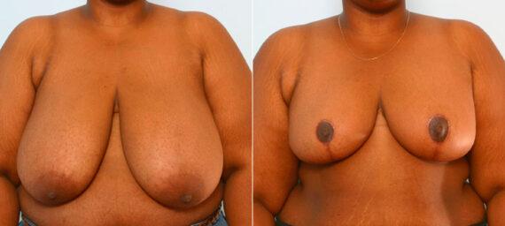 Breast Reduction result at Vitenas Cosmetic Surgery in Houston, TX