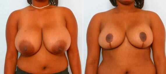 Vitenas Cosmetic Surgery breast reduction result — Houston, TX