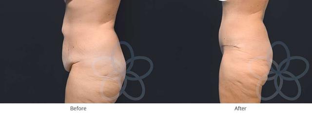 Mini Tummy Tuck result at Newvue Plastic Surgery in Bellevue, WA