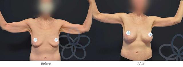 Arm Lift result at Newvue Plastic Surgery in Bellevue, WA