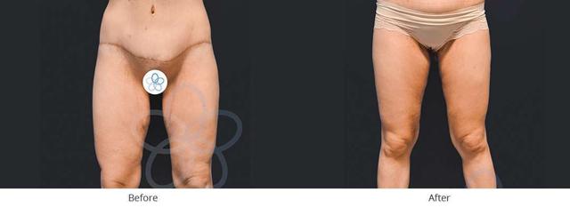 Thigh Lift result at Newvue Plastic Surgery in Bellevue, WA