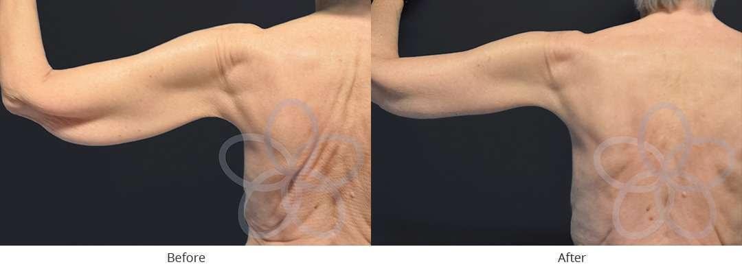 Newvue Plastic Surgery arm lift result — Bellevue, WA