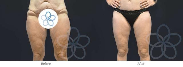 Thigh Lift result at Newvue Plastic Surgery in Bellevue, WA