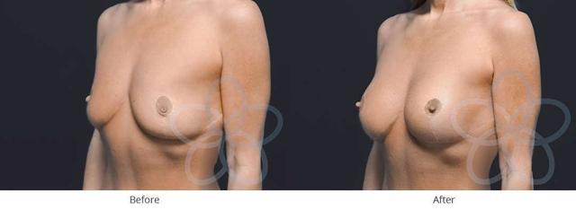 Breast Augmentation result at Newvue Plastic Surgery in Bellevue, WA