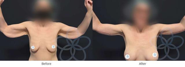 CoolSculpting result at Newvue Plastic Surgery in Bellevue, WA