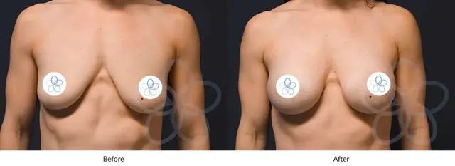 Breast Augmentation result at Newvue Plastic Surgery in Bellevue, WA
