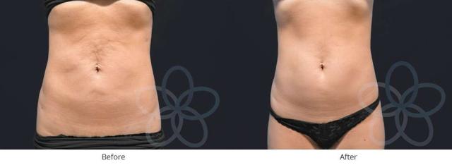 Liposuction result at Newvue Plastic Surgery in Bellevue, WA