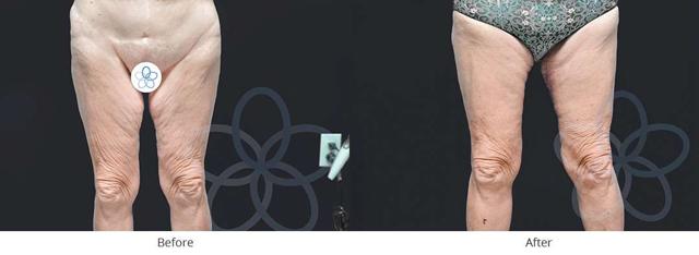 Thigh Lift result at Newvue Plastic Surgery in Bellevue, WA
