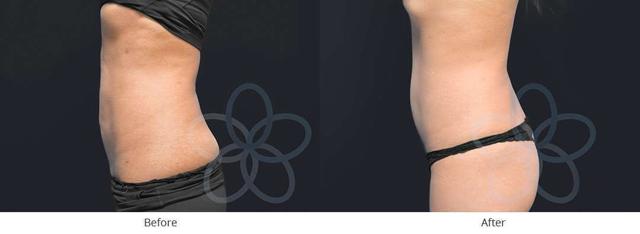 Liposuction result at Newvue Plastic Surgery in Bellevue, WA