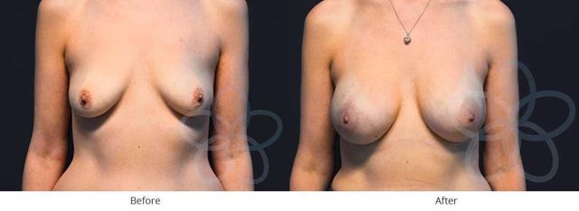Breast Augmentation result at Newvue Plastic Surgery in Bellevue, WA