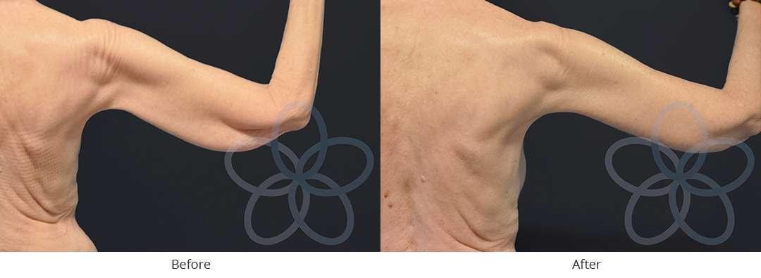 Newvue Plastic Surgery arm lift result — Bellevue, WA