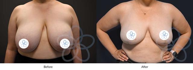Breast Reduction result at Newvue Plastic Surgery in Bellevue, WA