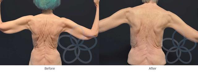CoolSculpting result at Newvue Plastic Surgery in Bellevue, WA