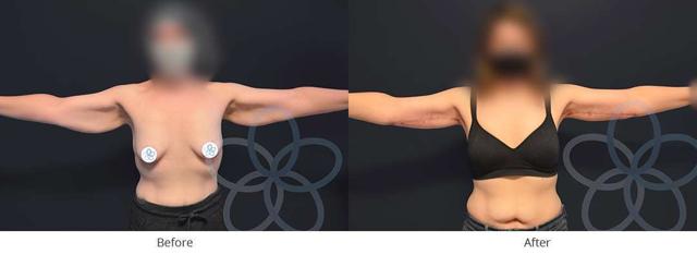 CoolSculpting result at Newvue Plastic Surgery in Bellevue, WA