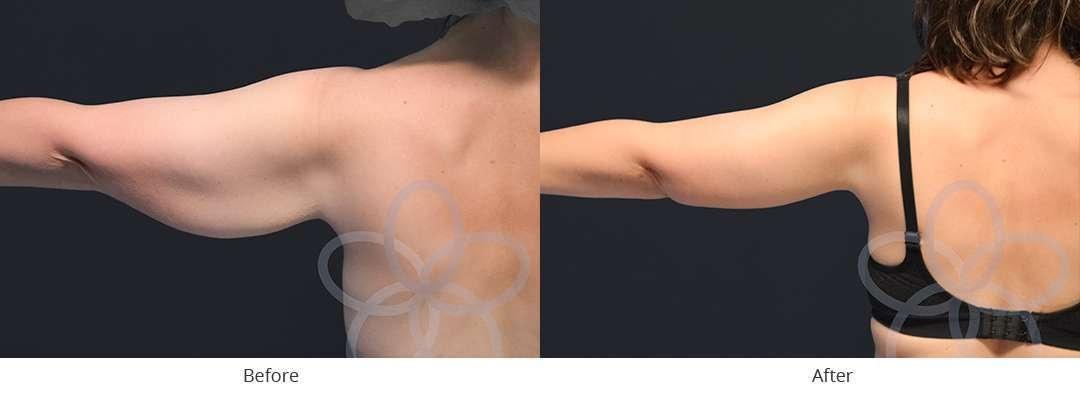 Newvue Plastic Surgery arm lift result — Bellevue, WA