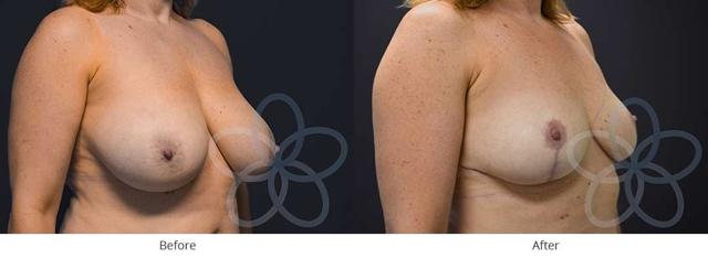 Breast Reduction result at Newvue Plastic Surgery in Bellevue, WA