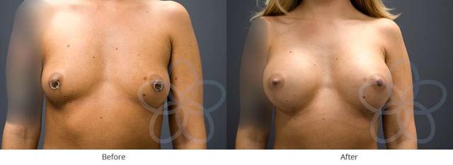 Breast Augmentation result at Newvue Plastic Surgery in Bellevue, WA
