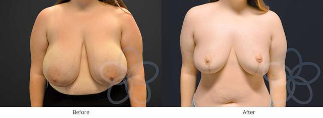Breast Reduction result at Newvue Plastic Surgery in Bellevue, WA