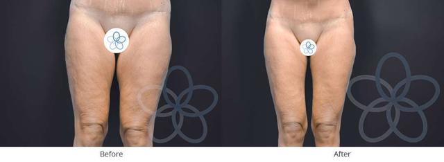 CoolSculpting result at Newvue Plastic Surgery in Bellevue, WA
