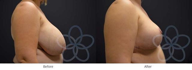 Breast Reduction result at Newvue Plastic Surgery in Bellevue, WA