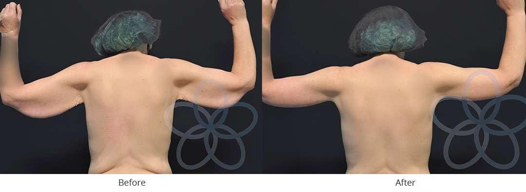 Newvue Plastic Surgery arm lift result — Bellevue, WA