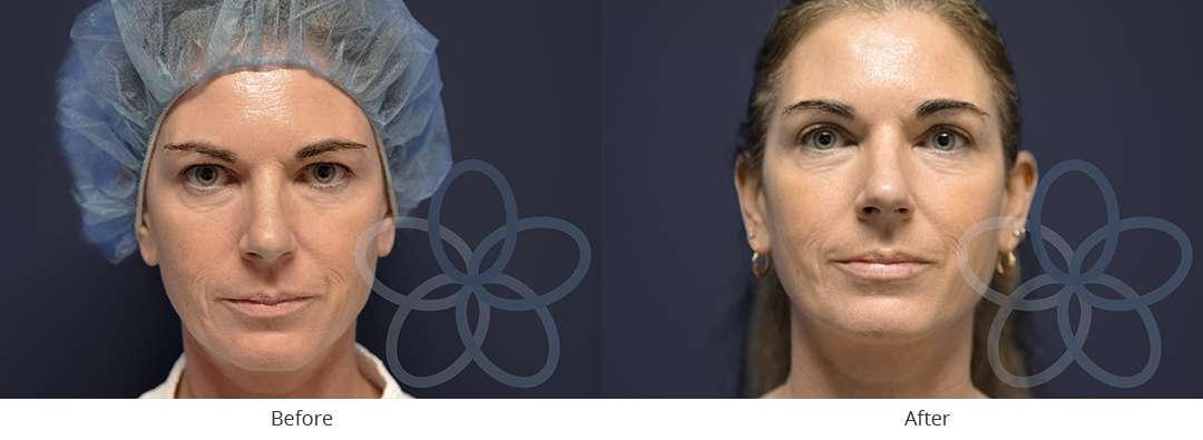 Newvue Plastic Surgery blepharoplasty result — Bellevue, WA