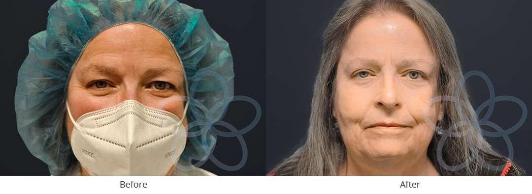 Newvue Plastic Surgery blepharoplasty result — Bellevue, WA